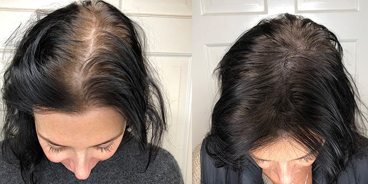 As they age, women lose their hair, too. Which treatments really work?